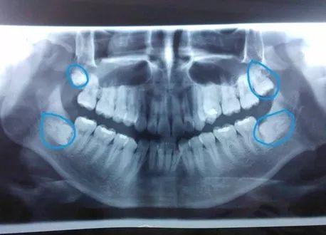 把智齿视频,从成因到治疗，全方位解析