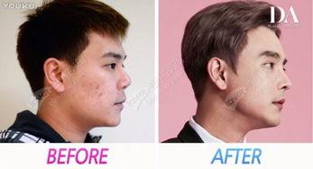 男整容视频,跟随男星脚步，探索颜值新境界